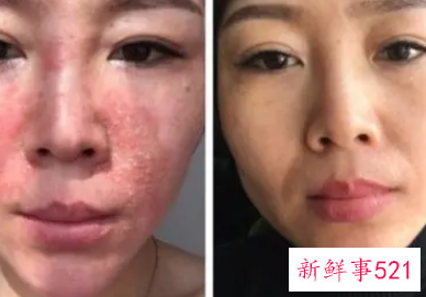 为什么脸上的黑色素沉积排不出来怎么办