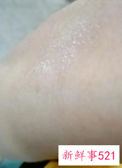 手臂上有米粒白色凸起痒