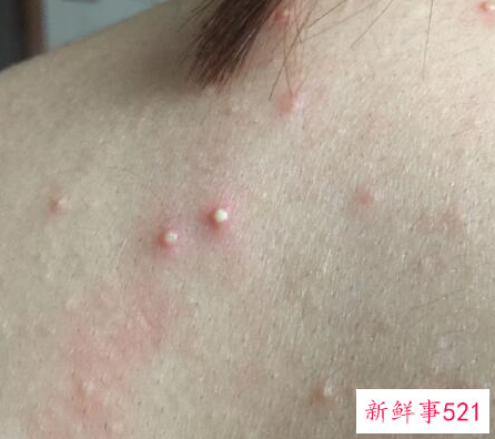 螨虫叮咬后的症状图