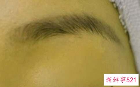 眉毛长痘痘的原因