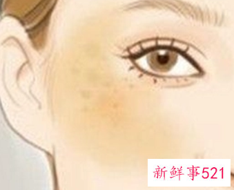 脸上有色斑怎么消除