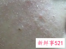 春天皮肤干燥起皮