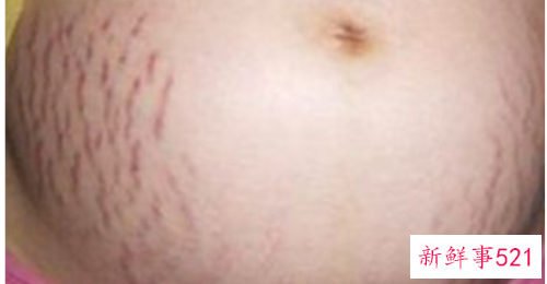 孕妈要怎么预防妊娠纹