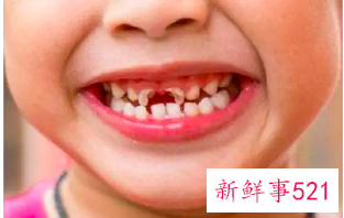 换牙期间要注意些什么