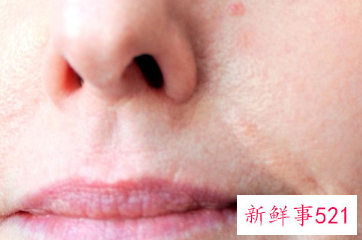 脸上起皮还痒还红怎么办