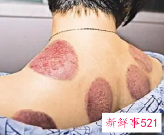 肩膀手臂拔罐都是黑的