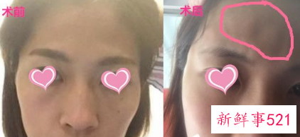 全脸脂肪填充案例