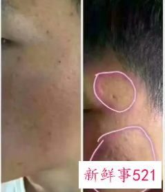 痘印怎么消得快一点