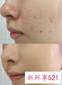 去除痘坑的最好方法