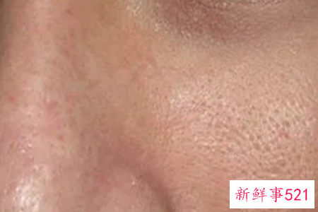 毛孔粗大是什么原因造成的呢