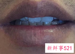 唇周围皮肤变黑是什么原因