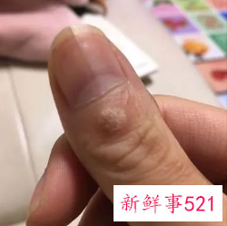 手指上有凸起的小疙瘩