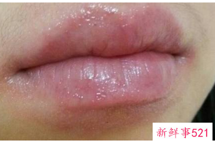 嘴角起皮擦什么