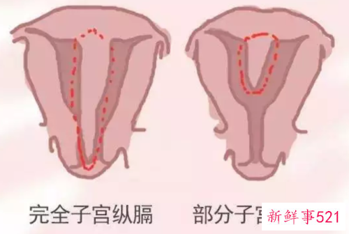 子宫纵隔为什么怀孕难