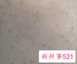 如何能去掉蝴蝶斑