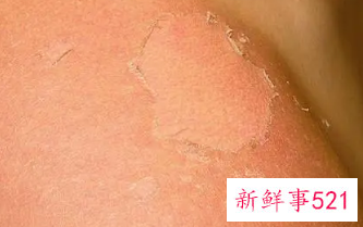 孩子脸上皮肤晒伤