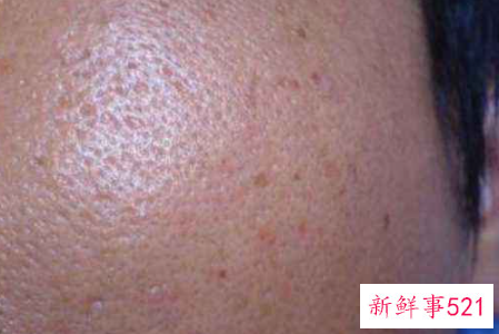 毛孔粗大是什么原因造成的呢