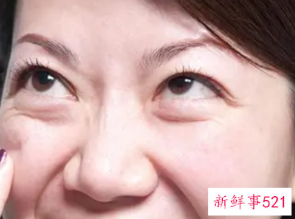 中老年治疗眼袋最有效的方法