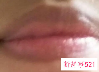 唇周围皮肤变黑是什么原因