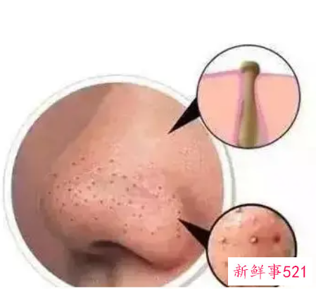 正确清理鼻子上的黑头产品