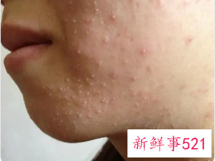 男生青春痘怎么才能消除