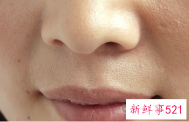 脸上总长粉刺怎么治疗