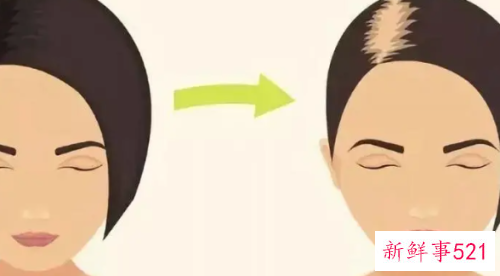 产后脱发严重怎么办呢