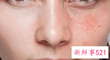 脸上起皮还痒还红怎么办
