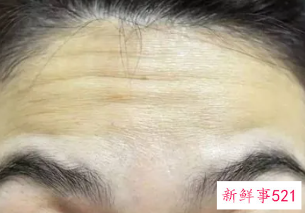 永久去抬头纹手术多少钱