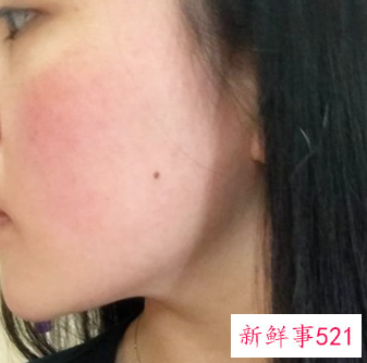 敏感肌会不会变成激素脸