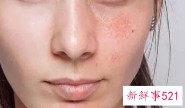 肌肤过敏征兆如何正确护理