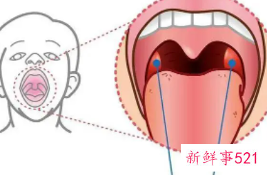 两岁小孩腺样体肥大怎么办