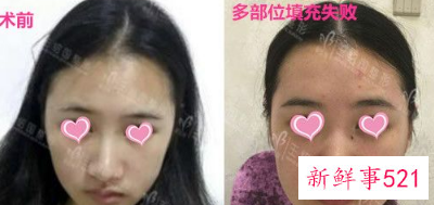 全脸脂肪填充案例