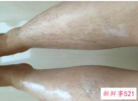 女生如何去除腿毛