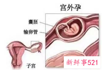 宫外孕流产症状是什么