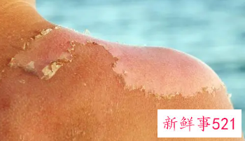 孩子脸上皮肤晒伤