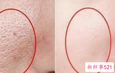 如何解决令人烦恼不已的毛孔粗大问题