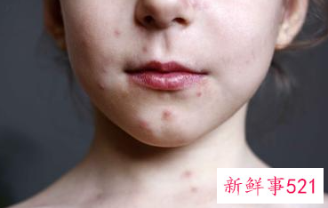 脸颊长痘痘是哪里的问题