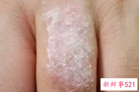 治牛皮癣偏方这13个省钱又高效