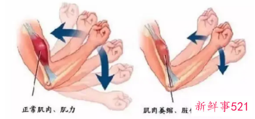 胳膊肌肉萎缩能不能恢复