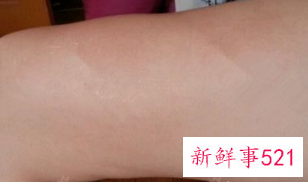 全脸脂肪填充案例