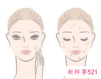 祛痘印的日常方法有哪些