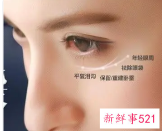 如何去除眼袋最有效