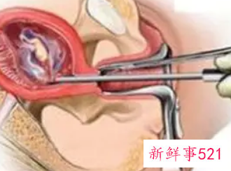 怀孕5个半月能打胎吗