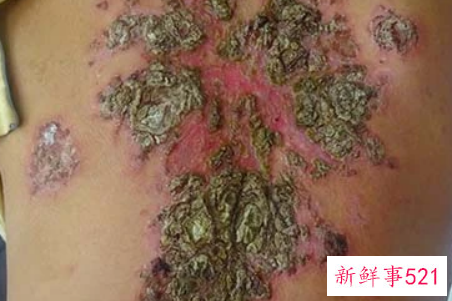治牛皮癣偏方这13个省钱又高效