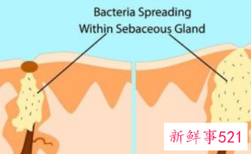 甲硝唑凝胶祛痘好用吗