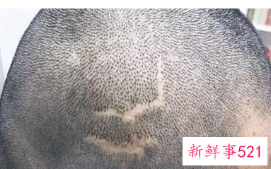 头部有疤不长头发