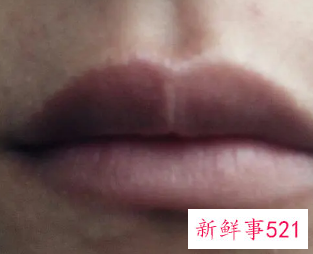 唇周围皮肤变黑是什么原因