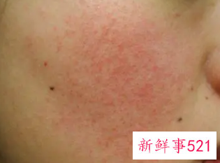 角质层受损能自愈吗