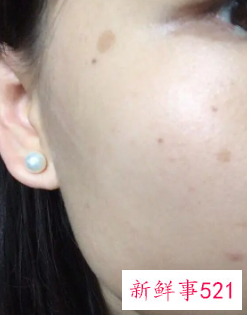 脸上晒出斑了怎么办